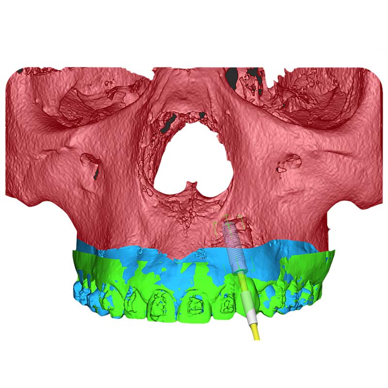 CBCT